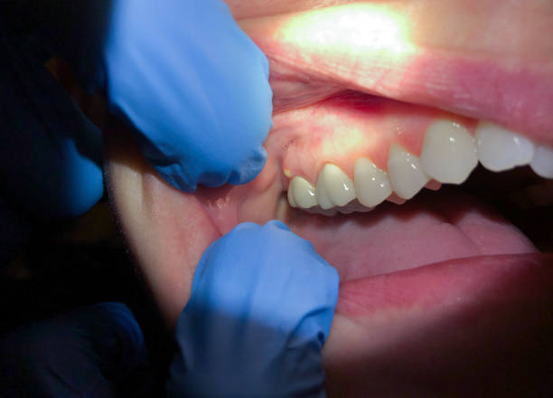 Best Chipped Tooth Repair Near Me  in Willcox, AZ